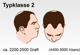 Haartransplantation Schweiz Typenklasse