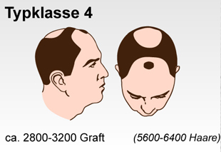 Haartransplantation Schweiz Typenklasse