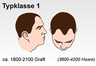 Haartransplantation Schweiz Typenklasse