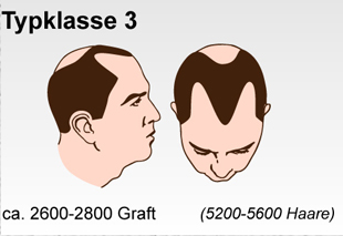 Haartransplantation Schweiz Typenklasse