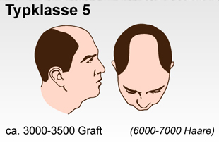 Haartransplantation Schweiz Typenklasse