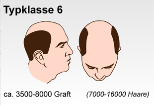 Haartransplantation Schweiz Typenklasse