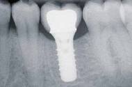 Implantat ist eine künstliche Zahnwurzel