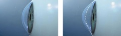 augenlasern