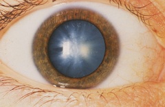 augenlasern