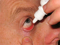 augenlasern