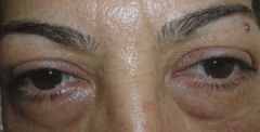 Augen