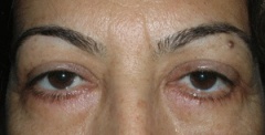 Retina